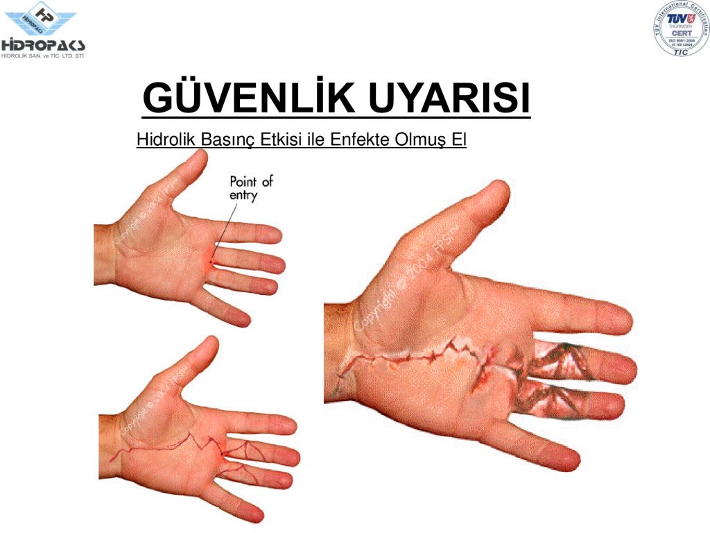 Hidro basınç ile enfekte olmuş el