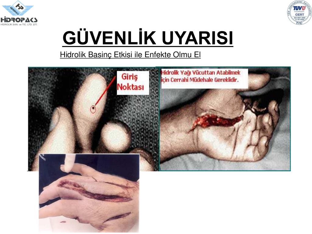 Hidrolik basınç ile enfekte olmuş el