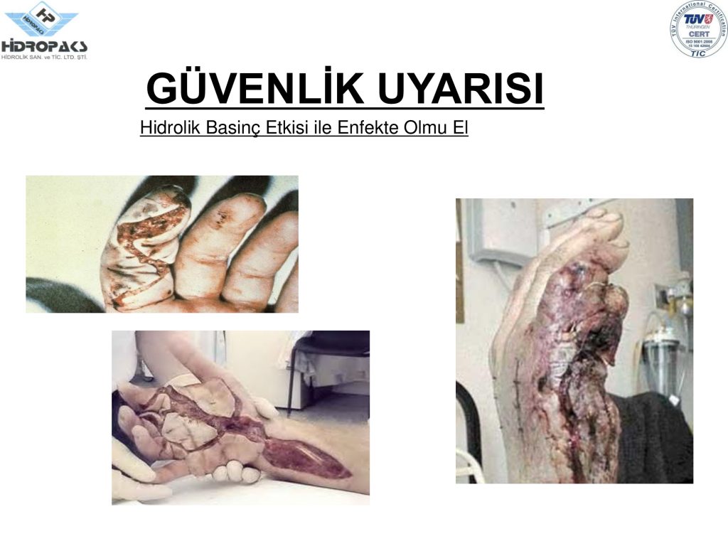 Hidrolik basınç ile enfekte olmuş el